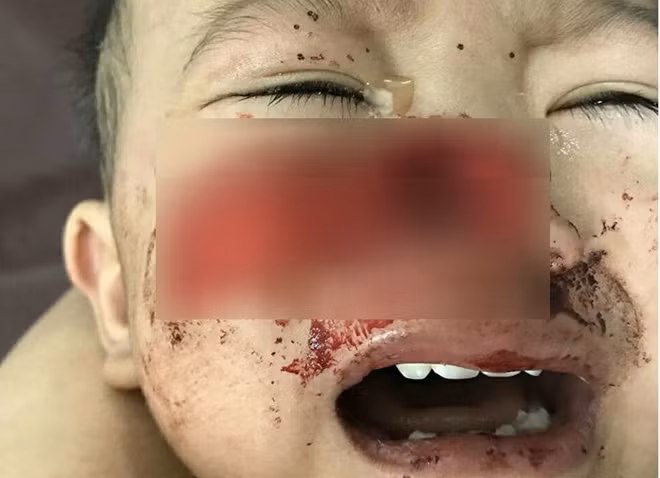 Một trường hợp trẻ bị tai nạn chó cắn thương tâm phải nhập viện Nhi đồng 1 TP Hồ Chí Minh. Một trường hợp trẻ bị tai nạn chó cắn thương tâm phải nhập viện Nhi đồng 1 TP Hồ Chí Minh.