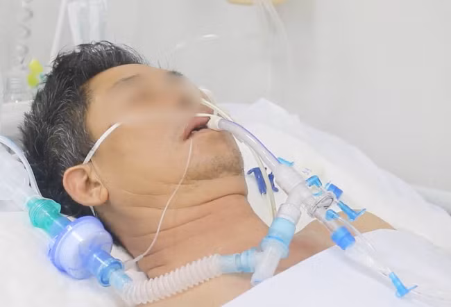 Bệnh nhân N.N.D dự kiến sẽ phải nằm thở máy cả tháng Bệnh nhân N.N.D dự kiến sẽ phải nằm thở máy cả tháng