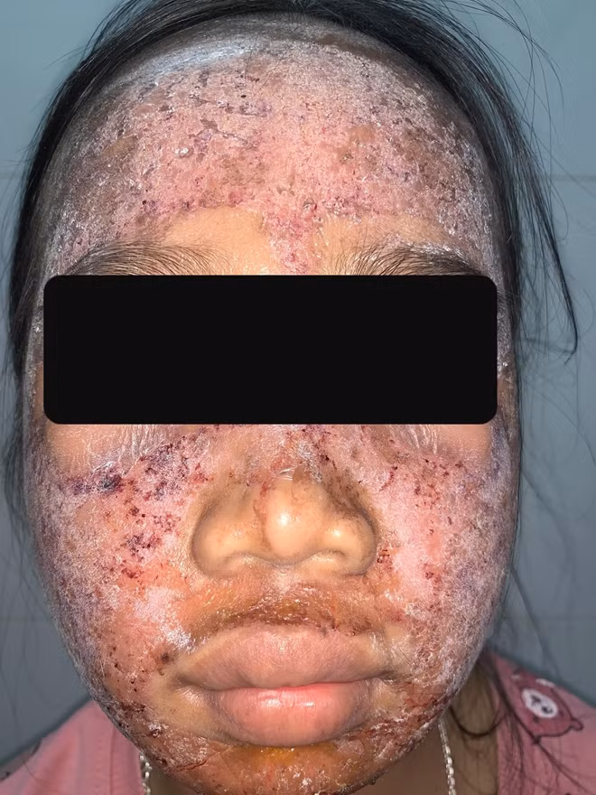 Da mặt cô gái 17 tuổi bị tàn phá nặng nề sau khi thoa thuốc 2 ngày