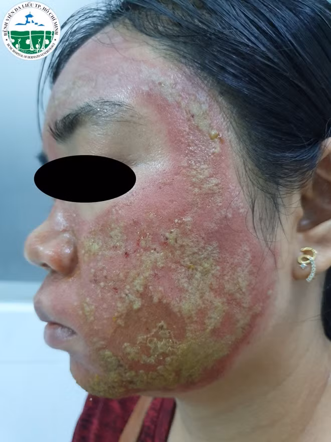 Khuôn mặt nữ bệnh nhân mưng đầy mủ sau khi thực hiện thủ thuật lăn kim làm đẹp.