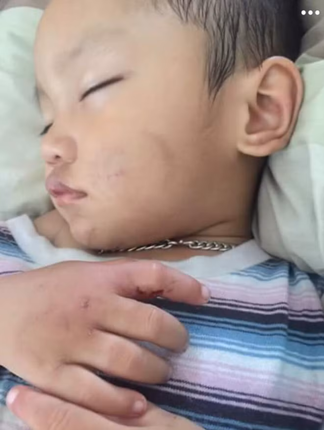 Vết bầm trên má cháu Trường