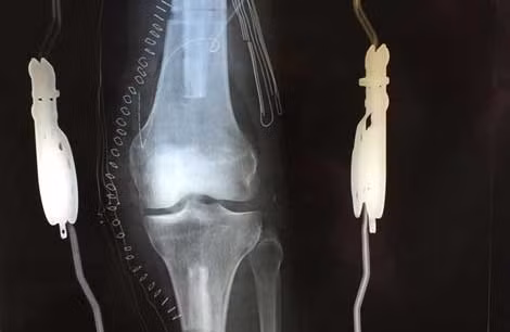 Hình ảnh siêu âm đầu gối bệnh nhân trước và sau khi phẫu thuật.
