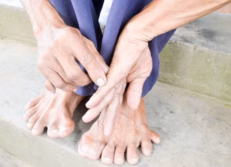 Đôi bàn tay, bàn chân nhiều ngón kỳ lạ của ông Lực.