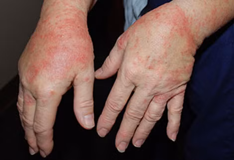 Một trường hợp dị ứng do dùng DDRTK.