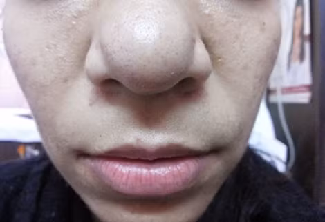 Mũi da gà, to dị dạng vì tiêm filler.