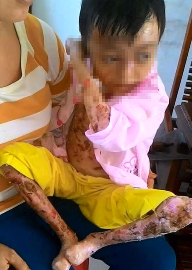 Em Trần Thị Thúy Hạnh đau đớn vì bong tróc từng mảng da thịt. Em Trần Thị Thúy Hạnh đau đớn vì bong tróc từng mảng da thịt.