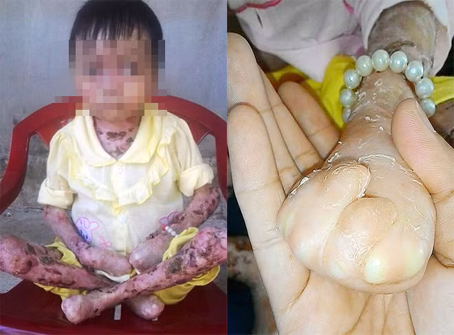 Bàn tay và chân em Hạnh đang bị liền da lại giống như bị cụt. Bàn tay và chân em Hạnh đang bị liền da lại giống như bị cụt.