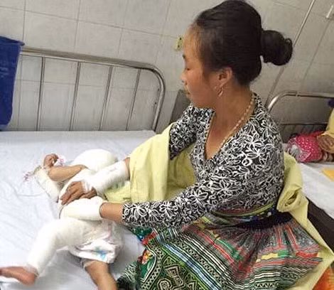 Cần trang bị kiến thức phòng tránh để trẻ em không bị bỏng.