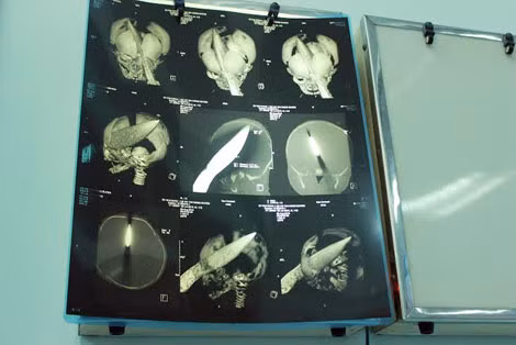 Hình ảnh tổn thương trong hộp sọ cháu bé qua chụp CT-Scan.