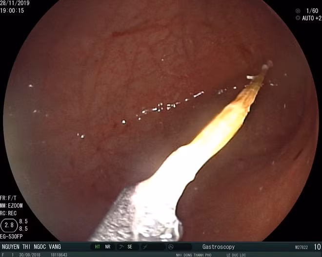 Cây tăm 5 cm nằm trong dạ dày bé gái.