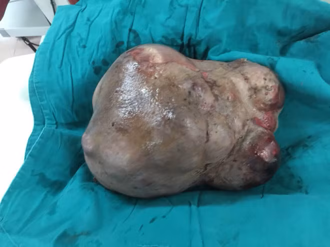 Khối u được bóc tách thành công có cân nặng 3kg.