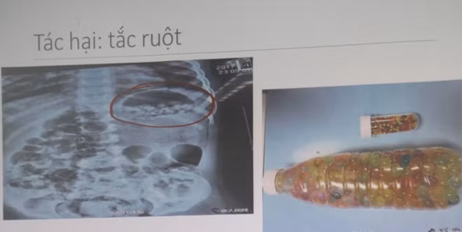 Hình chụp X-quang tình trạng trẻ bị tắc ruột khi ăn phải hạt nở và chai hạt nở có bán trên thị trường.