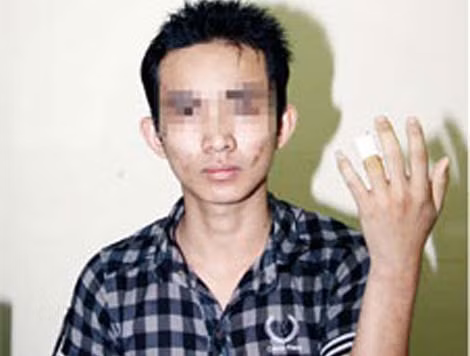 Nguyễn Minh Tân với ngón tay khiếm khuyết sau khi được Công an giải cứu. Nguyễn Minh Tân với ngón tay khiếm khuyết sau khi được Công an giải cứu.