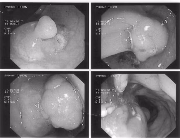 Ung thư trực tràng giai đoạn sớm và polyp lớn đại tràng chậu hông được cắt qua nội soi bằng kỹ thuật cắt niêm mạc. Ung thư trực tràng giai đoạn sớm và polyp lớn đại tràng chậu hông được cắt qua nội soi bằng kỹ thuật cắt niêm mạc.