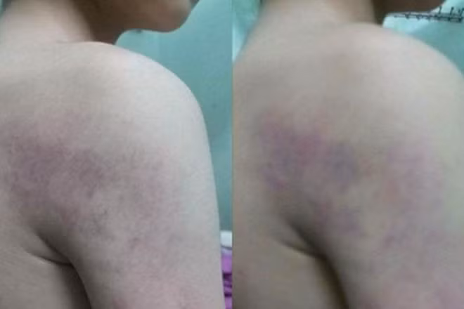 Phần bả vai của cháu T bị bầm tím một mảng. Phần bả vai của cháu T bị bầm tím một mảng.