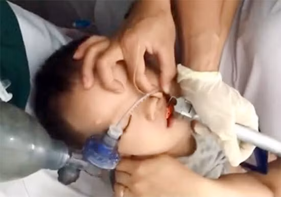Cháu K đang được các bác sỹ gắp từng miếng thach rau câu ra ngoài. Cháu K đang được các bác sỹ gắp từng miếng thach rau câu ra ngoài.