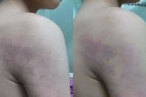 Tạm dừng đứng lớp với cô giáo đánh học sinh lớp 3 bầm tím lưng ảnh 3