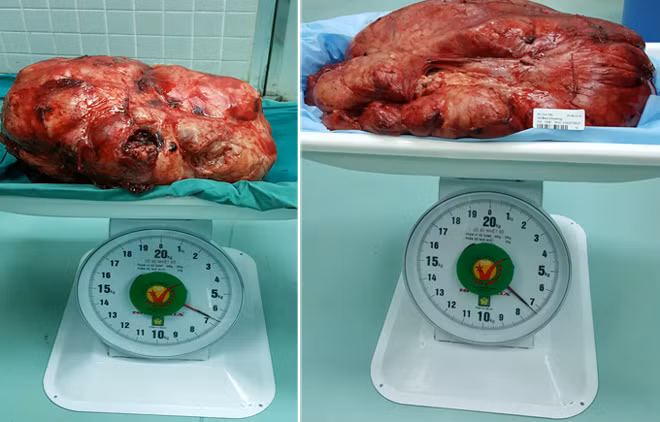 Những khối bướu "khủng" sau khi được bóc tách khỏi cơ thể 2 bệnh nhân.
