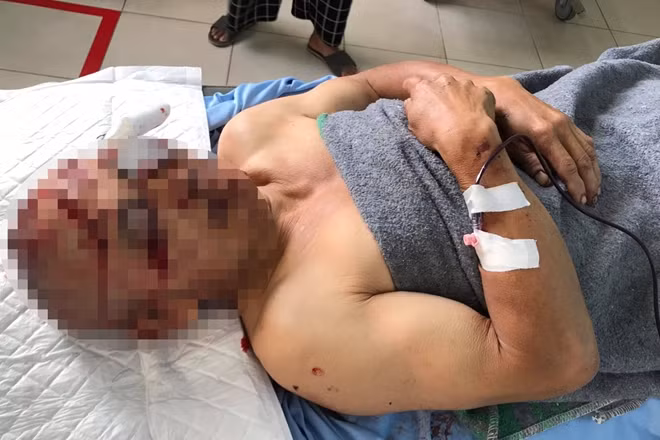 Ông Quách Văn Dĩnh bị tên cướp chém trọng thương