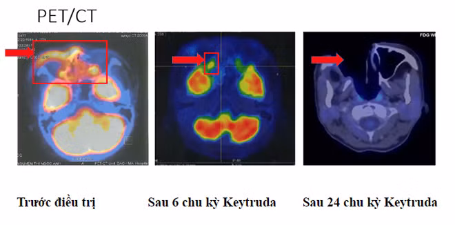 Sau 2 năm với 35 chu kỳ điều trị của Keytruda và theo dõi sát sao, người bệnh không có dấu hiệu tái phát - di căn.