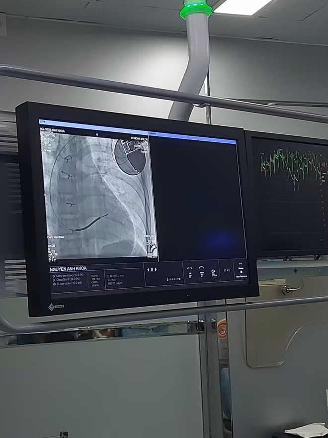 Bệnh nhi hồi phục sức khỏe tốt sau ca cấy ghép và có thể sớm xuất viện trong vài ngày tới.