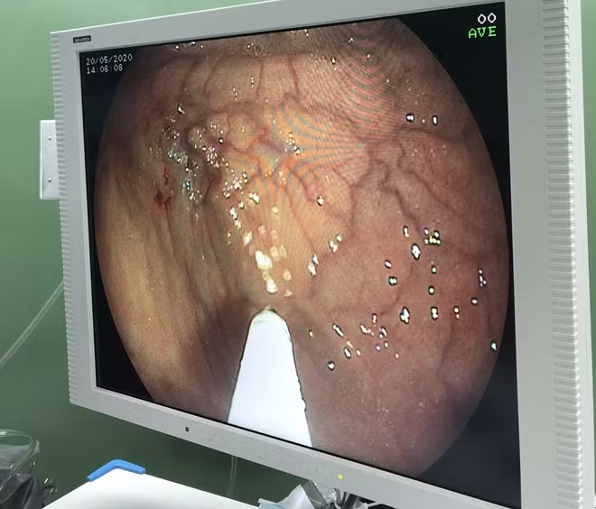 Các bác sĩ nội soi can thiệp thành công trong điều kiện người bệnh bị xơ gan mất bù có biến chứng xuất huyết tiêu hóa nặng kèm nhiều bệnh lý phức tạp.