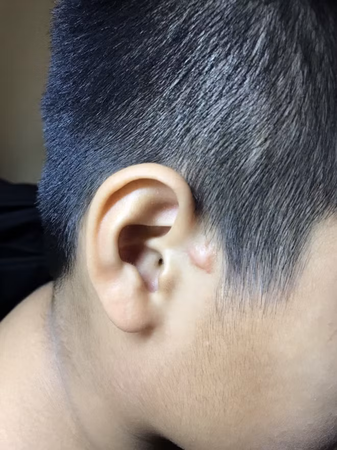 Vết sẹo trên tai bé P. bị thương năm lớp 3 phải may 9 mũi