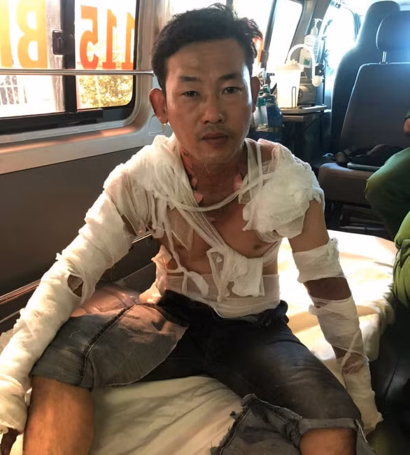 Tài bị bỏng nặng sau khi tự chế xăng vào người đốt