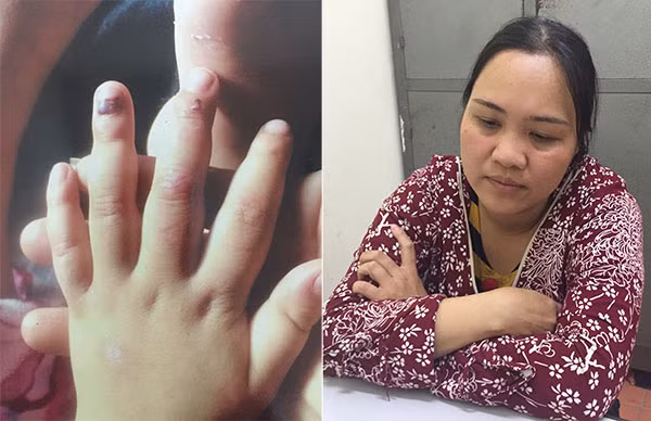 Những vết bầm dập trên móng tay cháu bé do bị đánh đập và đối tượng Vũ Thị Hải.