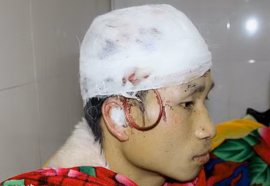 Anh Hân đang điều trị tại Bệnh viện huyện Quế Phong Anh Hân đang điều trị tại Bệnh viện huyện Quế Phong