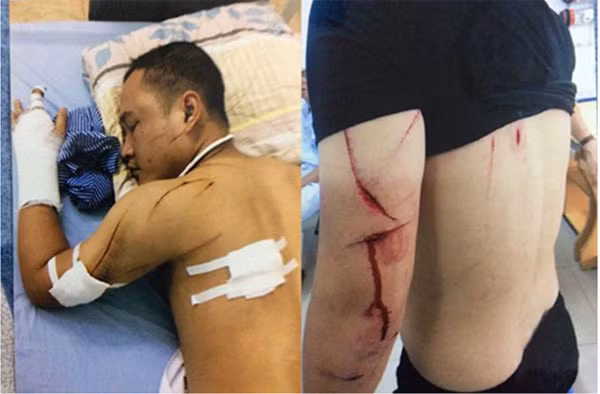 Những vết thương trên người anh Luyện do bị các đối tượng đâm chém.
