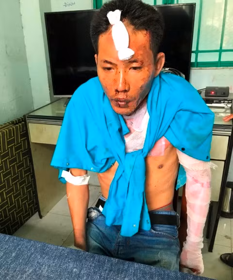 Dũng cũng bị bỏng nhẹ sau khi tạt xăng đốt 3 mẹ con chị Huệ.