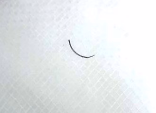 Dị vật chiếc kim khâu được lấy ra khỏi mí mắt bà H..
