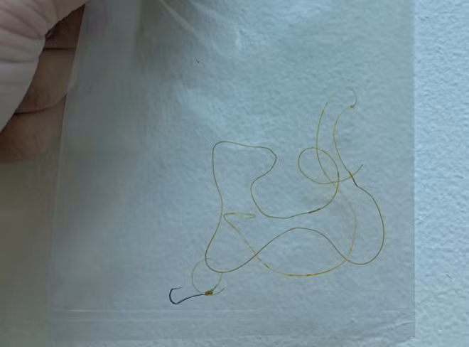 Lưỡi câu và dây cước dài 40cm được lấy ra từ ruột bệnh nhân Ng..