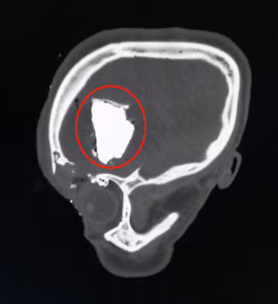 Hình ảnh chụp CT tổn thương trong não bệnh nhân sau tai nạn.