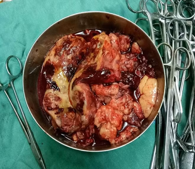 Khối u trung thất gần 2 kg trong lồng ngực bệnh nhân R. được bóc tách thành công.
