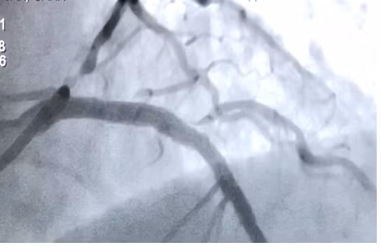 Và sau khi đặt stent máu đã lưu thông đều.