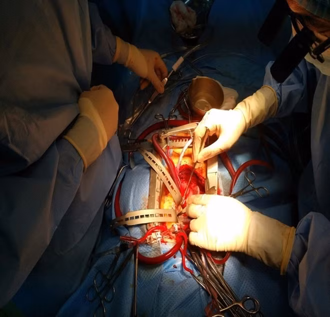 Các bác sĩ BVĐKTƯ Cần Thơ, đang phẫu thuật tim cho bệnh nhân.