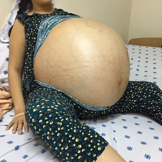 Bệnh nhân T. với khối u nang "siêu khủng" trước khi phẫu thuật.