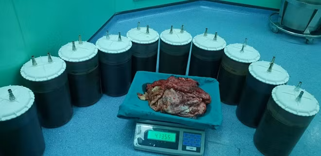 48 lít dịch và 3kg vỏ khối u nang trong người bệnh nhân T. được các bác sỹ BVĐHYD TP Hồ Chí Minh lấy ra.