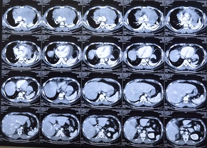 Hình ảnh khối u trung thất trên phim CT-Scan