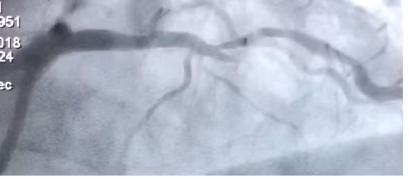 Động mạch của bệnh nhân C trước khi đặt stent