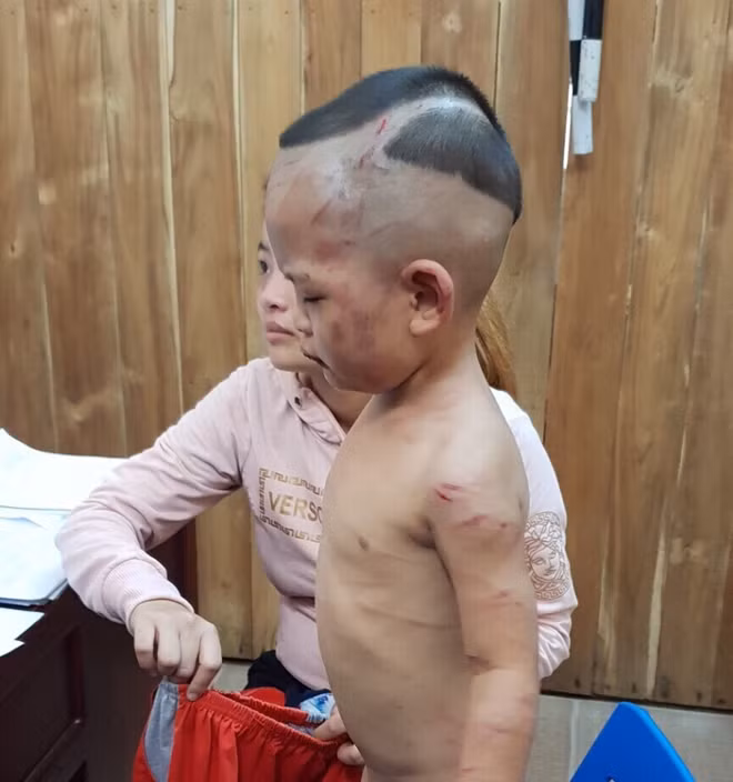 Cháu H. bị gã cha dượng đánh đập dã man, hiện đang điều trị tại BVĐK Kiên Giang.