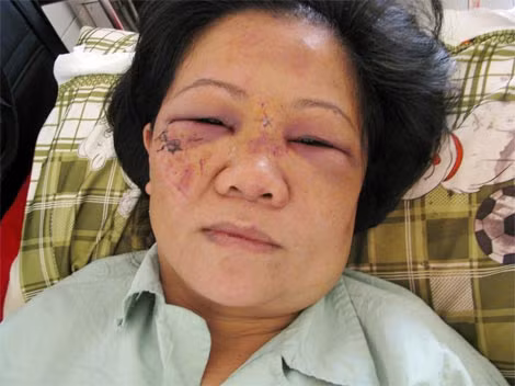 Chị Lò Thị Thu Nguyệt bị chồng hành hung phải nhập viện điều trị.