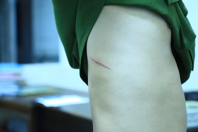 Một vết thương khác của Trung úy Thông