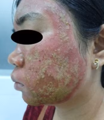 Khuôn mặt của nữ bệnh nhân sau khi làm đẹp.