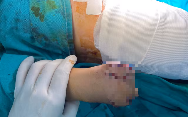 Đốt pháo, anh K. bị nổ chấn thương vùng mặt và tay.