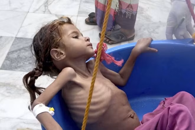 Một bé gái Yemen bị suy dinh dưỡng đang được cân kiểm tra sức khỏe. Ảnh: AP
