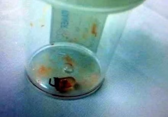 Dị vật được gắp ra khỏi phổi cho bé trai.