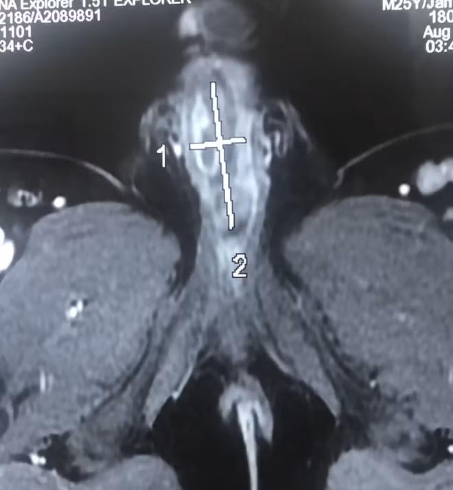 Hình chụp MRI chỉ rõ có dị vật bện trong.